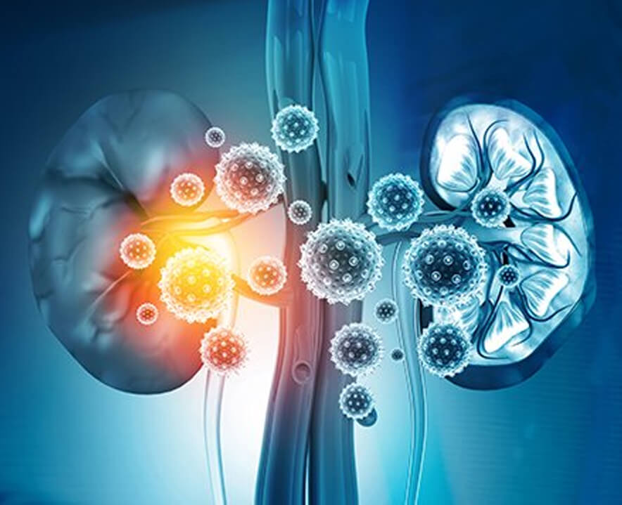 Covid-19 Guidance For Patients With Kidney Disease