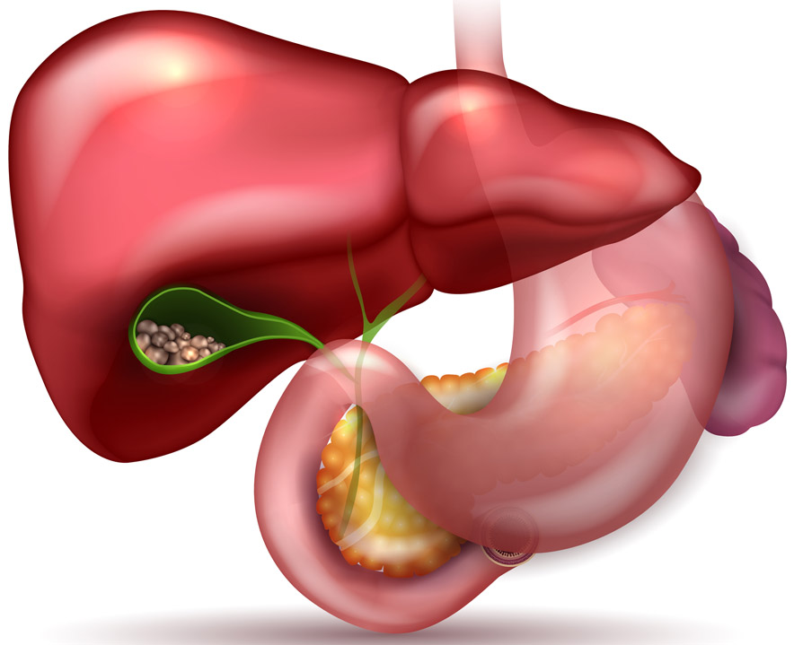 6 Ways to Prevent Gallbladder Stones
