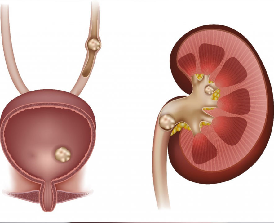Understanding Kidney Stones – Causes, Symptoms and Prevention